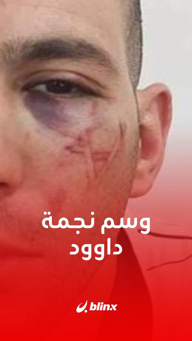 "نجمة داوود".. وسم على وجه معتقل فلسطيني