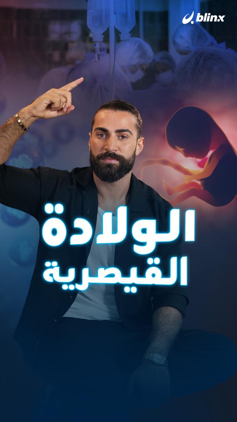 الولادة القيصرية