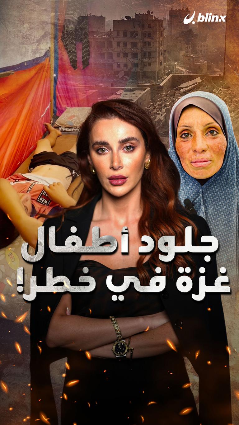 جلود أطفال غزة في خطر!