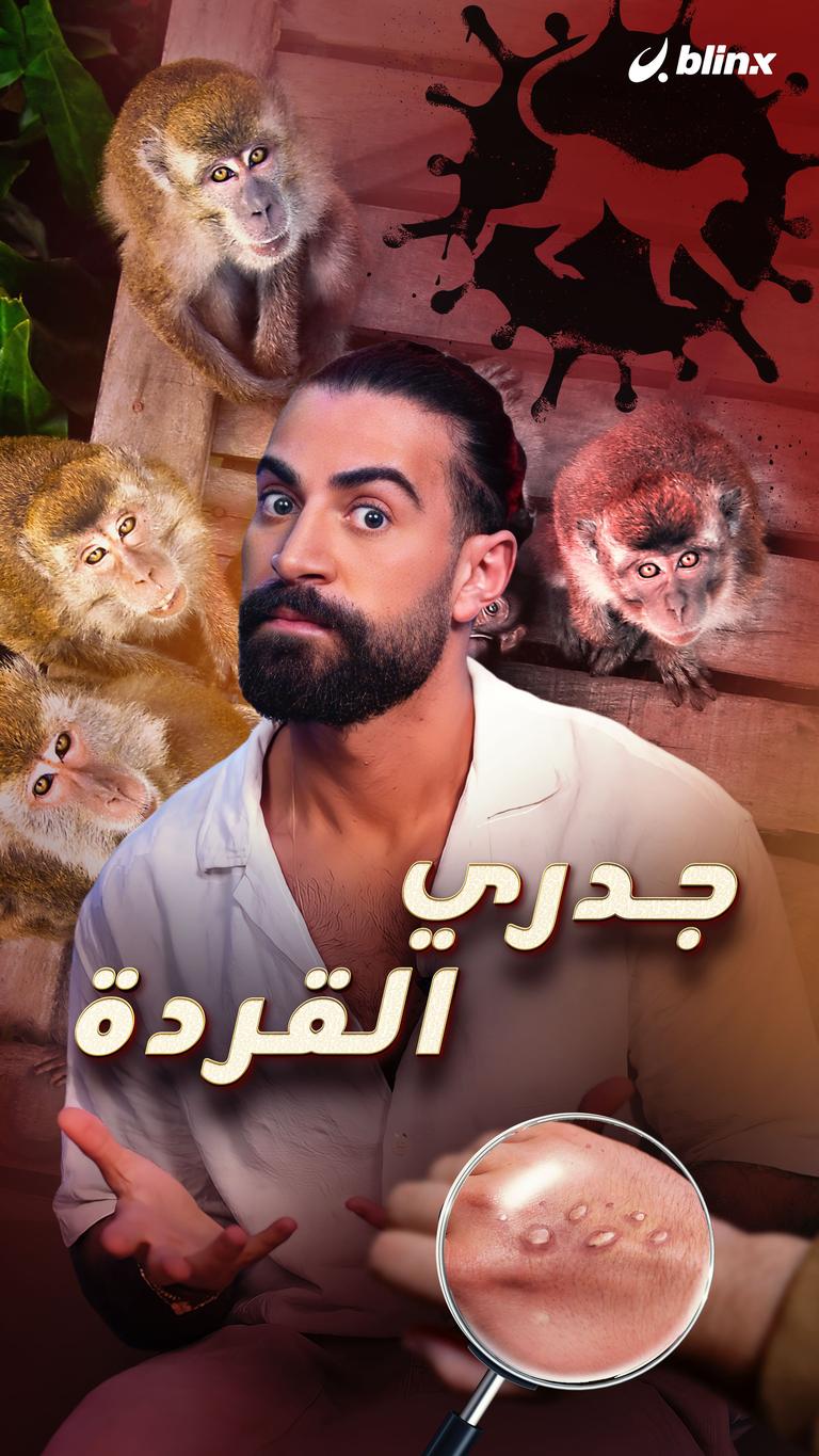 جدري القردة